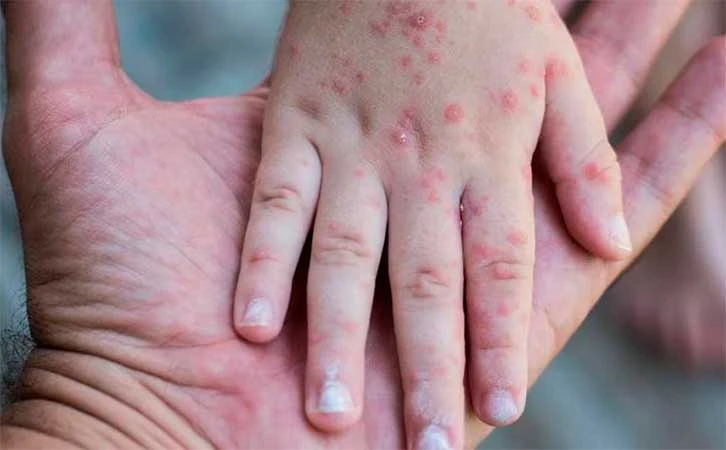 Oposición exige garantizar vacunas contra el sarampión