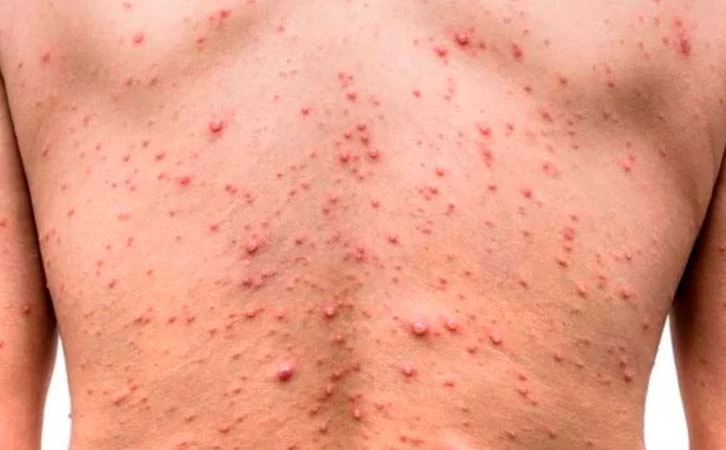 CDMX encabeza la lista de mayor número de contagios de mpox en México